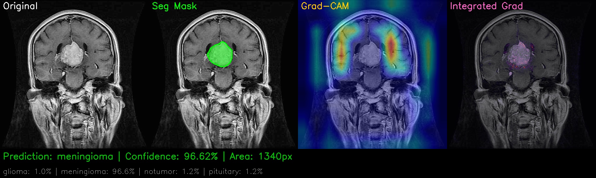 NeuroSight system output showing segmentation and explainability overlays